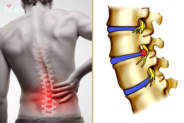 Thoát vị đĩa đệm nặng đến mức không đi lại được – và sự thay đổi sau 30 ngày trị liệu tại Bảo Minh Đường
