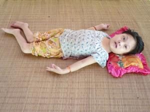 Điều trị bại liệt tại Bảo Minh Đường – Lương y Cao Văn Minh đồng hành cùng người bệnh trên hành trình phục hồi