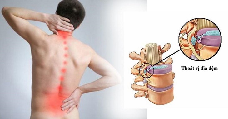 Thoát vị đĩa đệm – Khi cơn đau âm thầm làm thay đổi cả cuộc sống và con đường hồi phục tại Bảo Minh Đường