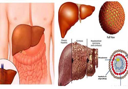 Điều đáng sợ của viêm gan B không phải là bệnh – mà là sự chủ quan
