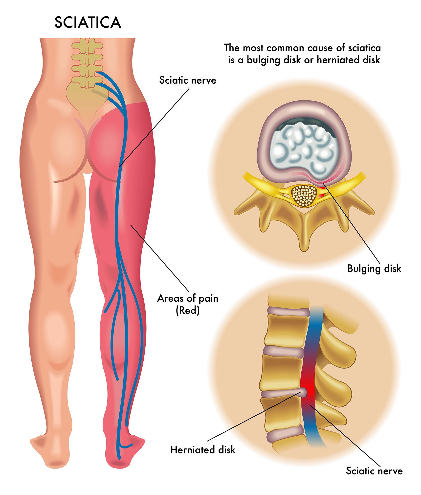 Hỏi – Đáp: Thoát vị đĩa đệm có khỏi hoàn toàn được không?