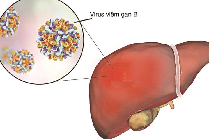 Viêm gan B không chỉ là virus – mà là cuộc chiến âm thầm của gan